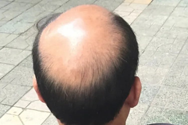 脱发1-7级程度图片