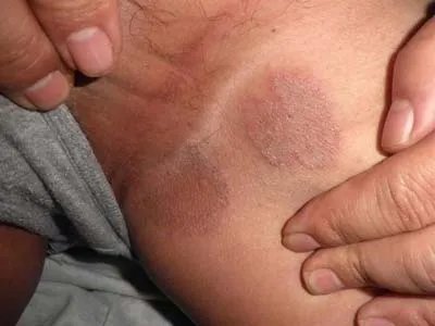 女性股癣图片初期图片