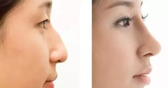 硅胶垫鼻子得多少钱