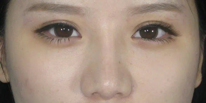 做鼻综合多少钱