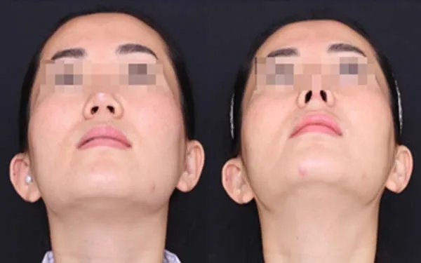 北京玻尿酸隆鼻多少钱