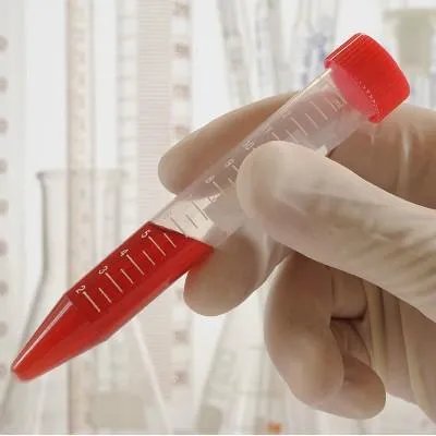 尿酸高是什么引起的呢