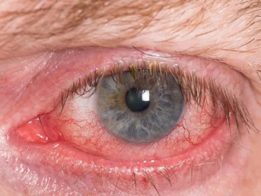 左眼皮跳是怎么回事