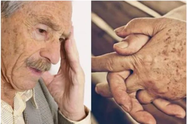 老年斑是怎么形成的呢？