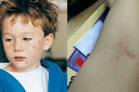 水痘初期症状图片展示