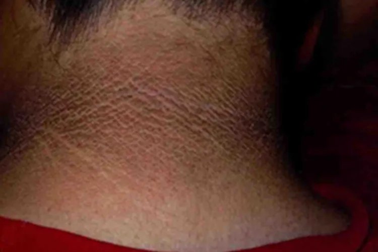 黑棘皮病后颈症状图片