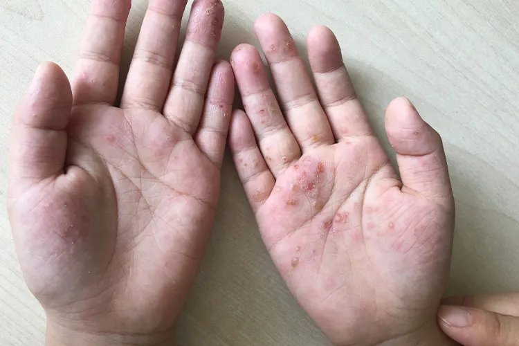 汗疱疹的症状图片