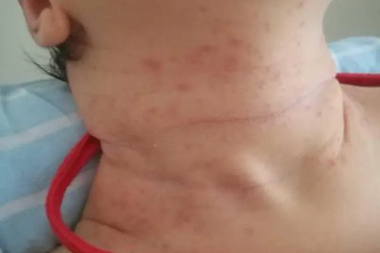 宝宝脖颈处湿疹图片