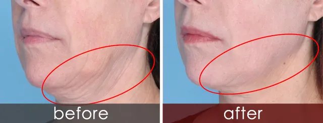 做拉皮除皱费用大概需要多少