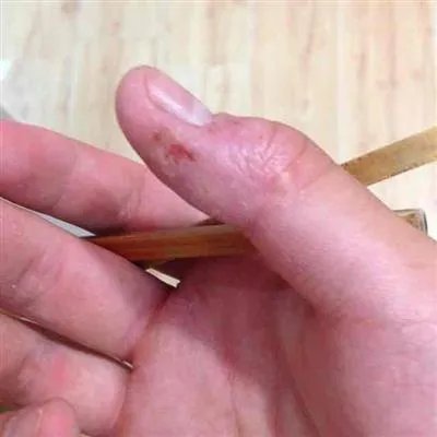 汗疱疹是什么原因引起的?