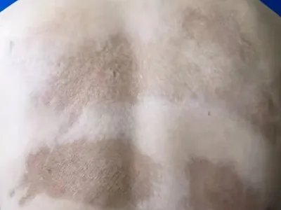 Pasini-Pierni进行性特发性皮肤萎缩斑图片