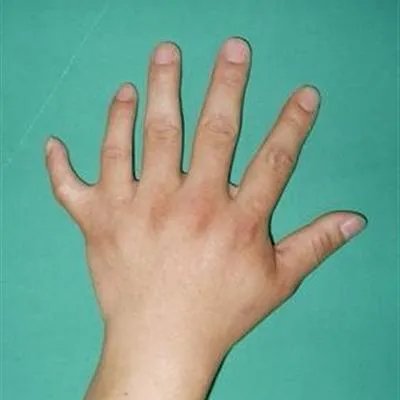 手脚发麻是怎么回事