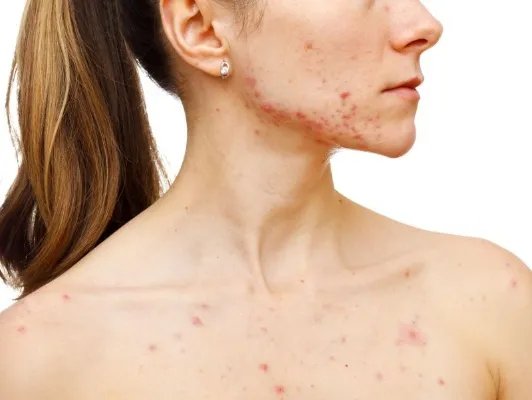 太阳穴长痘痘是什么原因