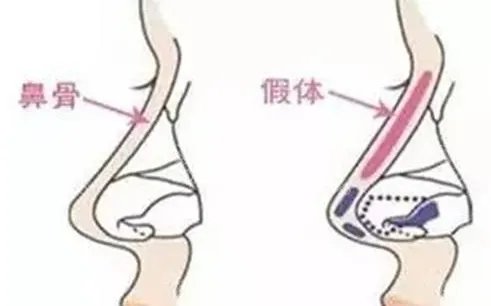 深圳哪家医院假体隆鼻好