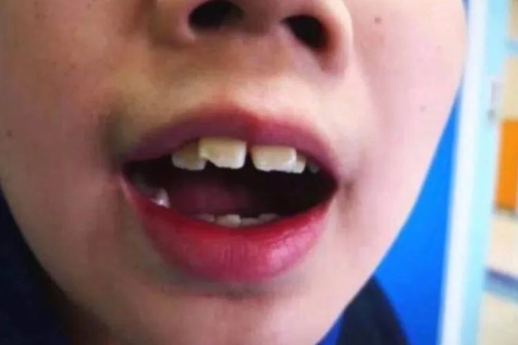 腺样体肥大的面容图片