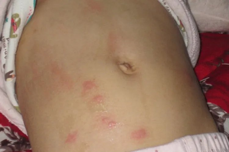 过敏性皮炎图片