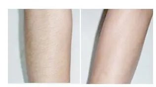 激光脱毛有副作用吗