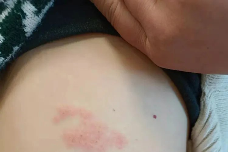 幼儿急疹的症状图片