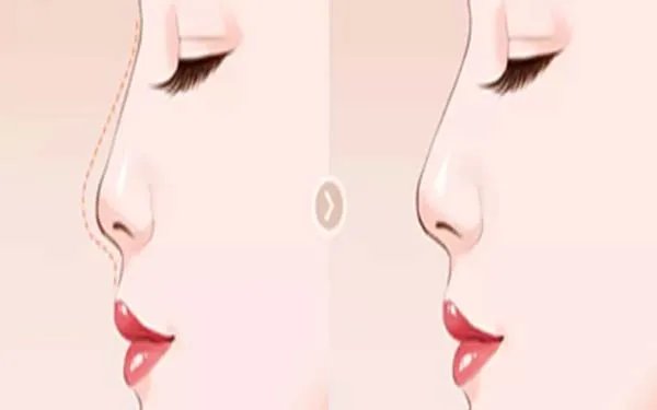 北京肋软骨隆鼻医院哪里比较好