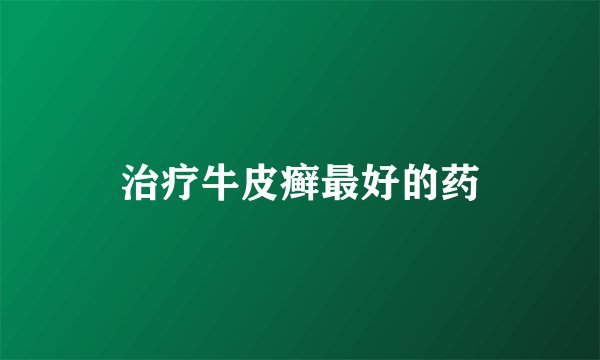 治疗牛皮癣最好的药