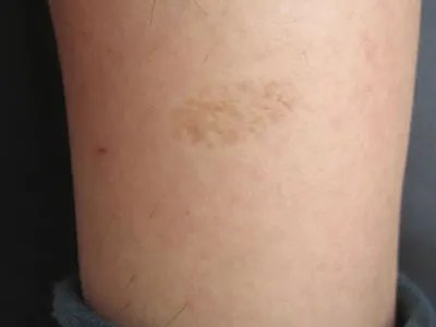 Pasini-Pierni进行性特发性皮肤萎缩斑图片