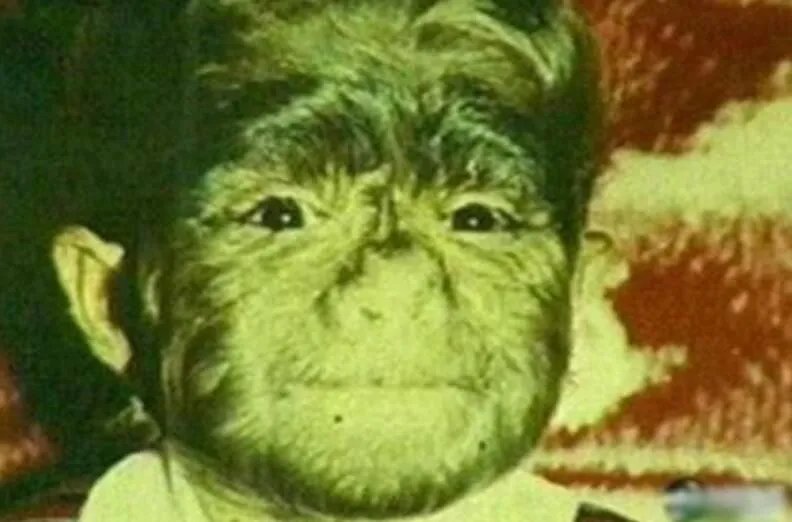 狼孩卡马拉的故事说明了什么问题 为什么没有形成人的正常心理