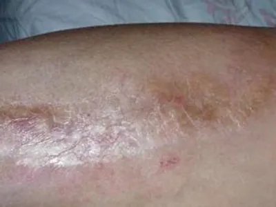 Pasini-Pierni进行性特发性皮肤萎缩斑图片