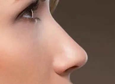 深圳哪家医院假体隆鼻好