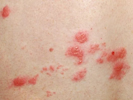 小儿手足口病的症状