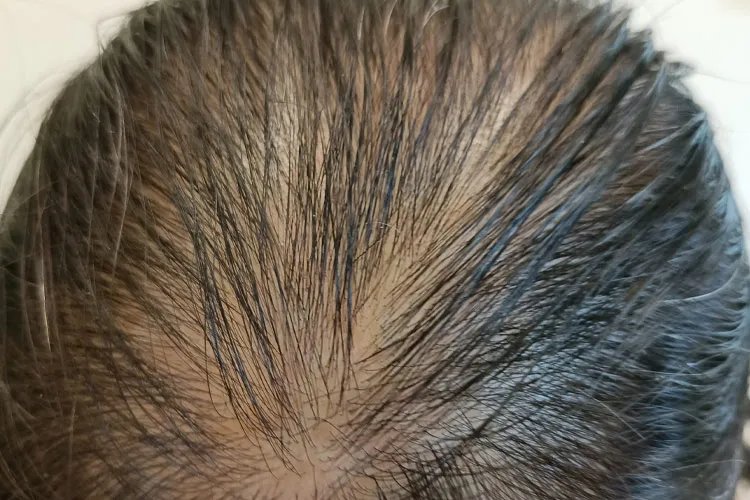 脱发1-7级程度图片