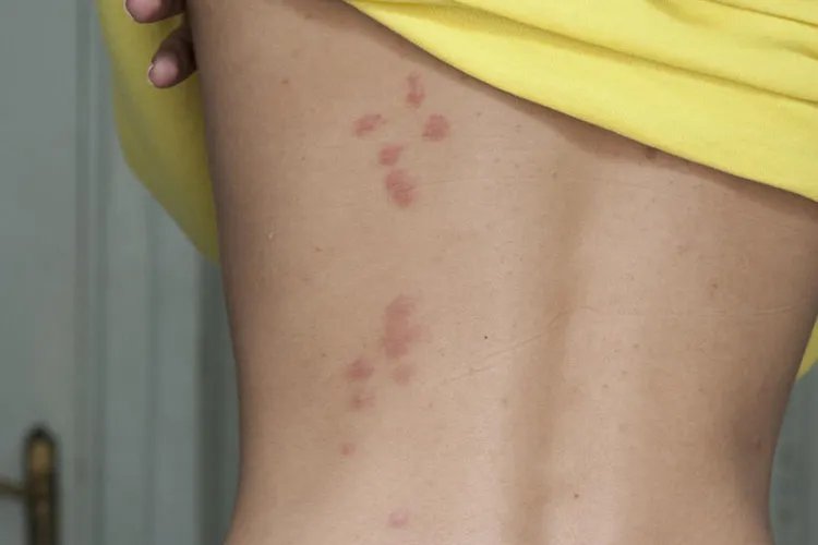 被床虱咬了是什么样子图片