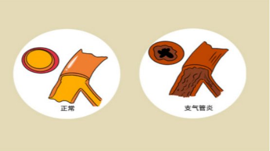 喘息性支气管炎是什么