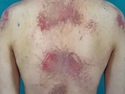 成人Still病症状图片