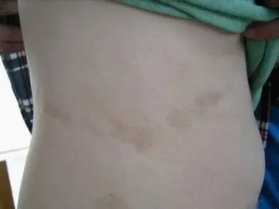 Pasini-Pierni进行性特发性皮肤萎缩斑图片