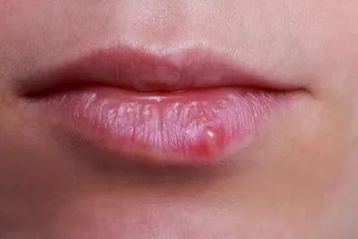 上火嘴唇起泡怎么办