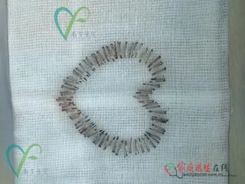 整形案例：揭秘毛发种植全过程