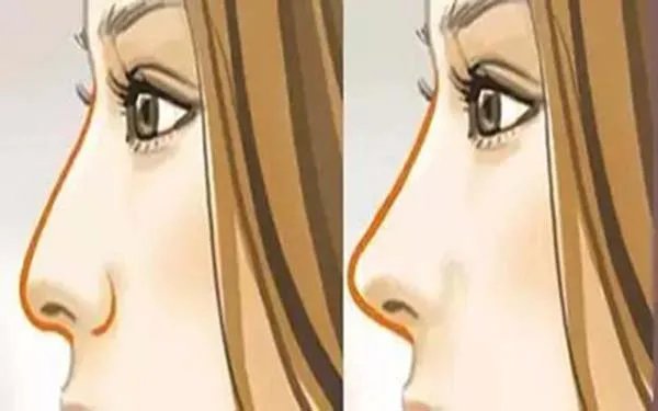 北京肋软骨隆鼻医院哪里比较好