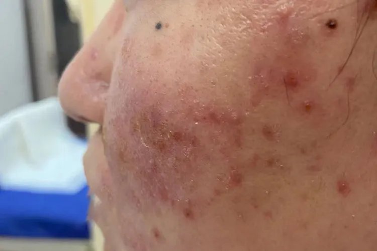 过敏性皮炎图片