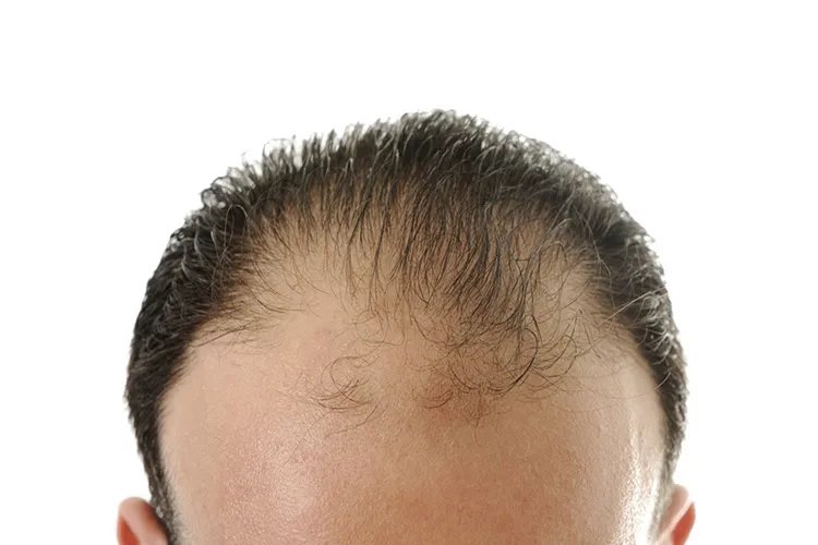 脱发1-7级程度图片