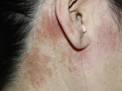 成人Still病症状图片