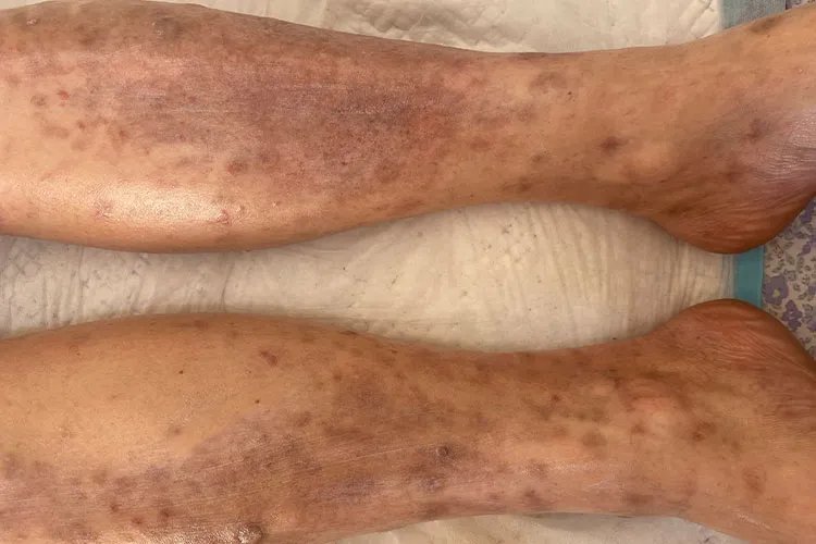 过敏性皮炎图片