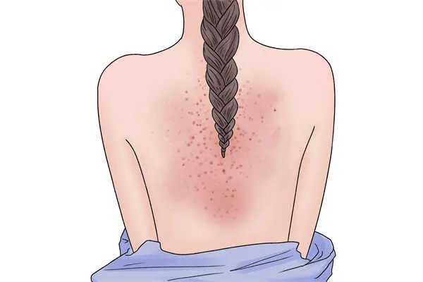 药物过敏有哪些症状