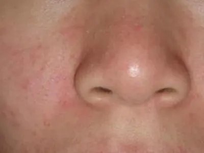 成人Still病症状图片