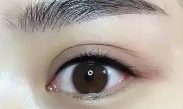 做双眼皮埋线的坏处