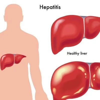 肝癌有传染性吗