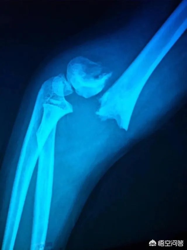 重庆一女童在幼儿园摔骨折，家长怀疑是老师报复，你怎么看？