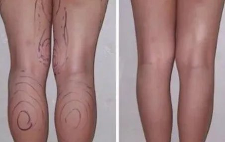 botox瘦腿副作用有哪些