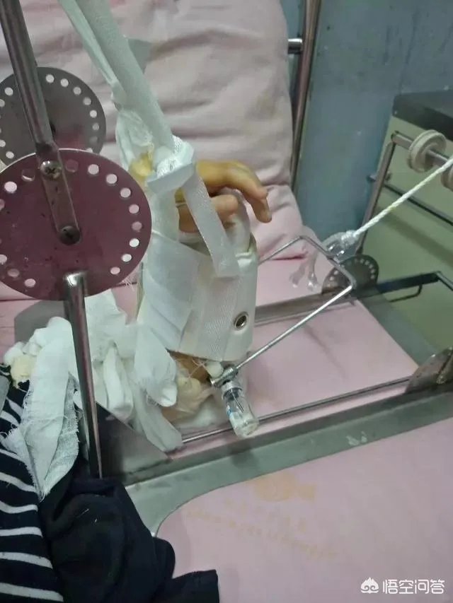 重庆一女童在幼儿园摔骨折，家长怀疑是老师报复，你怎么看？