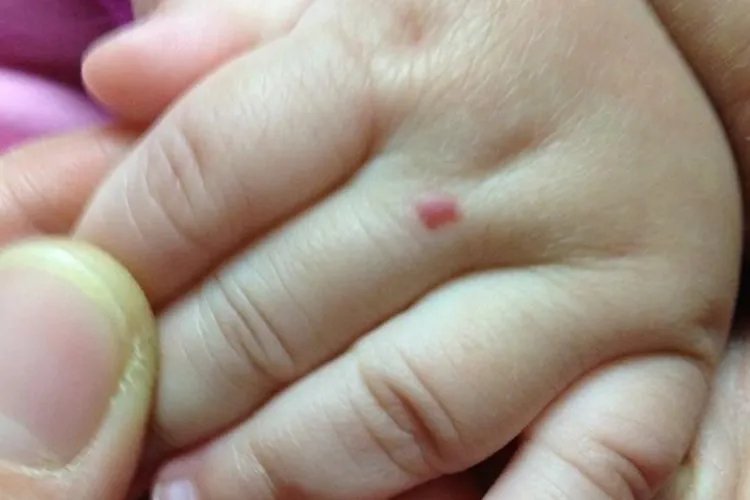 血管瘤最开始的图片