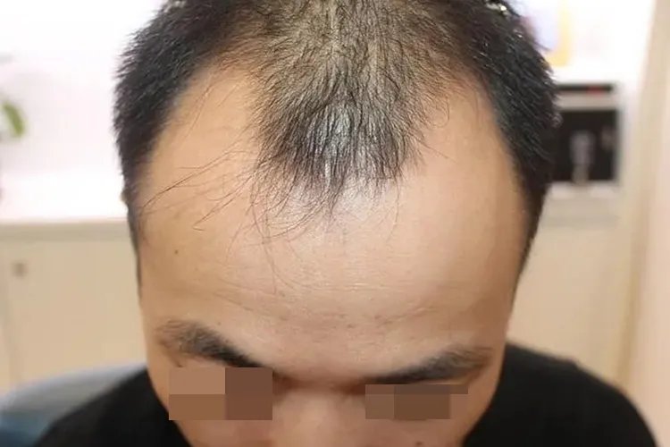 脱发1-7级程度图片